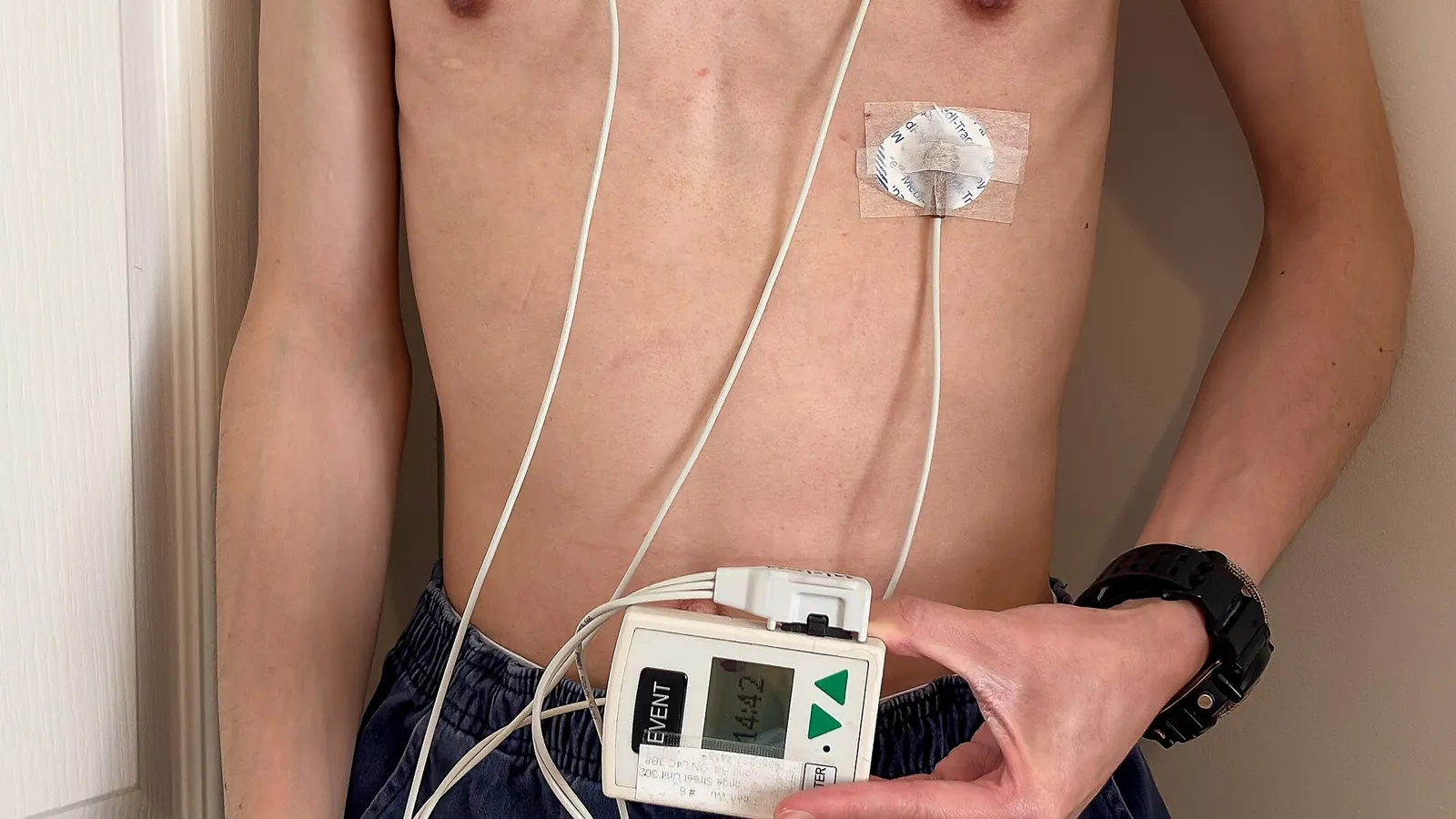 Patient wearing a Holter ECG recorder with chest electrodes