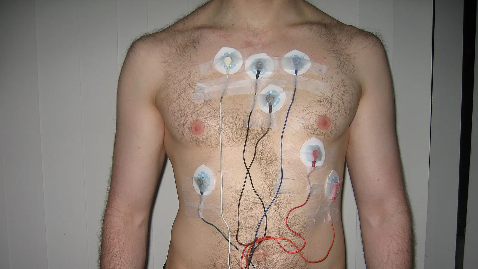 ECG electrodes and lead wires arranged on a monitoring setup